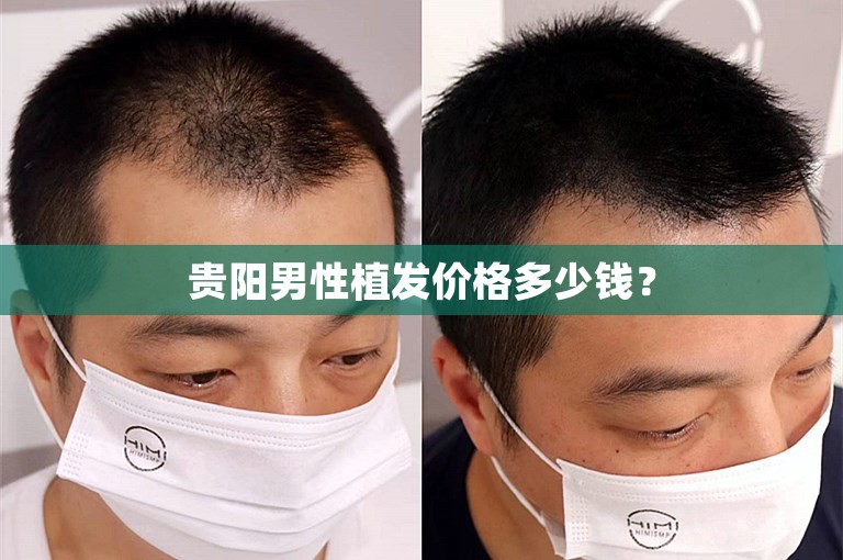 贵阳男性植发价格多少钱？