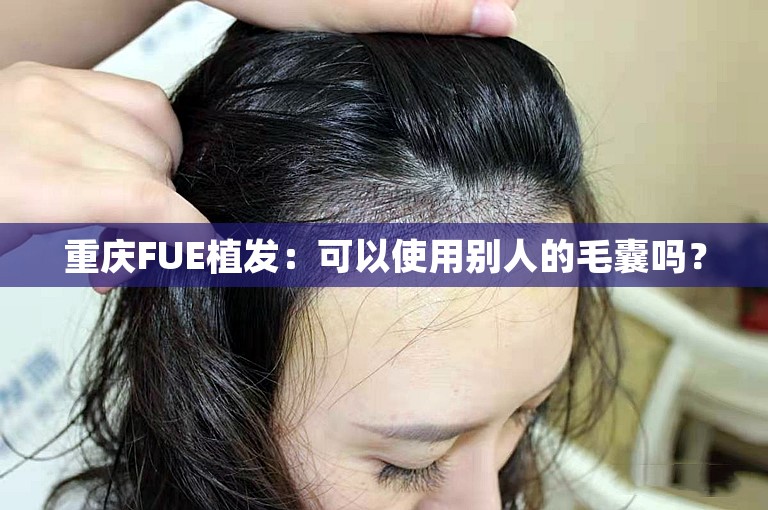 重庆FUE植发：可以使用别人的毛囊吗？