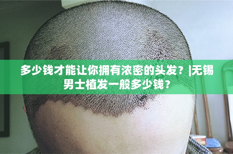 多少钱才能让你拥有浓密的头发？|无锡男士植发一般多少钱？