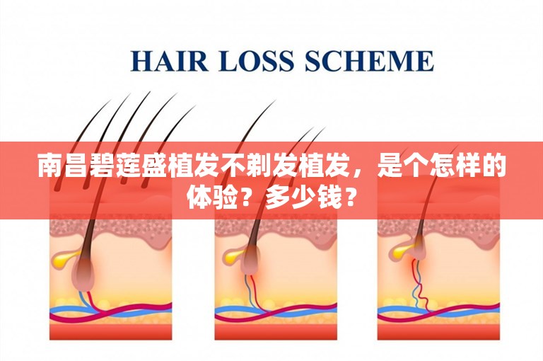 南昌碧莲盛植发不剃发植发，是个怎样的体验？多少钱？