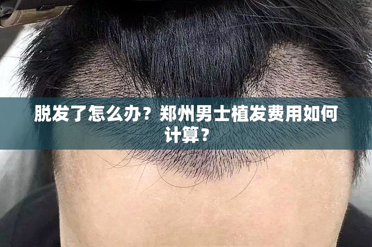 脱发了怎么办？郑州男士植发费用如何计算？