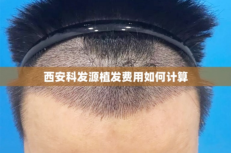 西安科发源植发费用如何计算