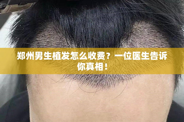 郑州男生植发怎么收费？一位医生告诉你真相！