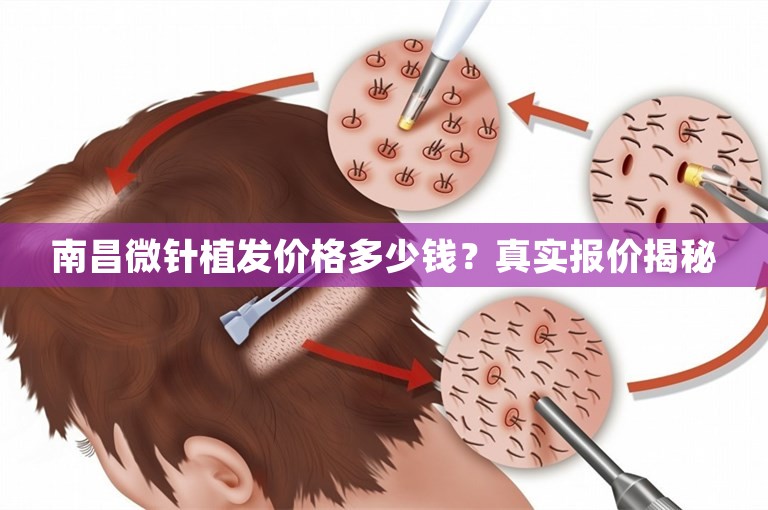 南昌微针植发价格多少钱？真实报价揭秘