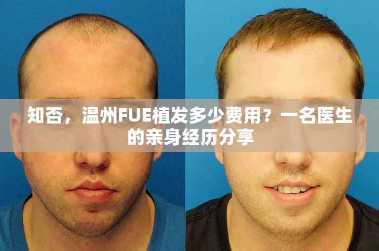 知否，温州FUE植发多少费用？一名医生的亲身经历分享