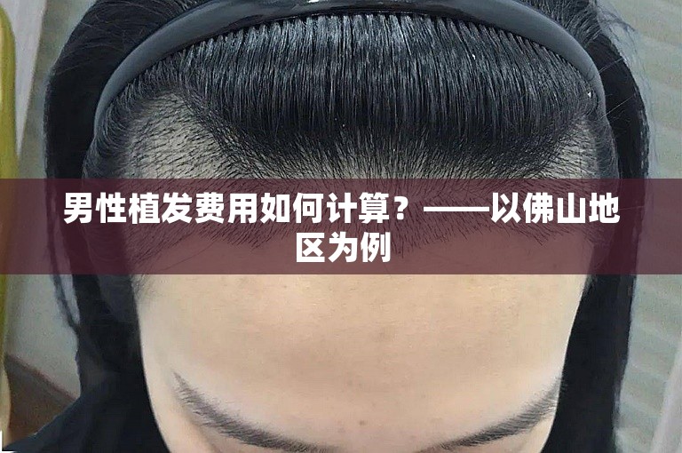 男性植发费用如何计算？——以佛山地区为例