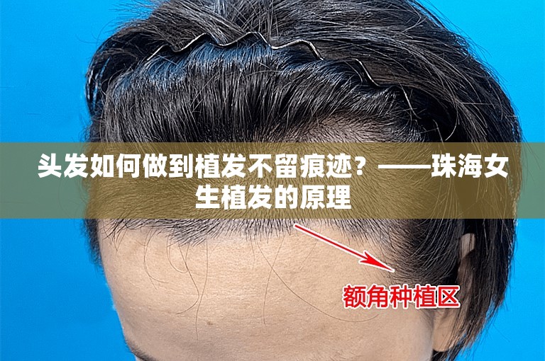 头发如何做到植发不留痕迹？——珠海女生植发的原理