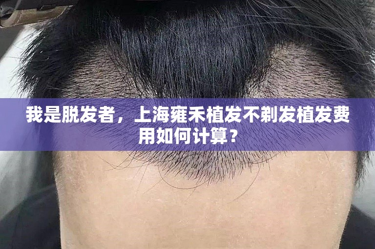 我是脱发者，上海雍禾植发不剃发植发费用如何计算？