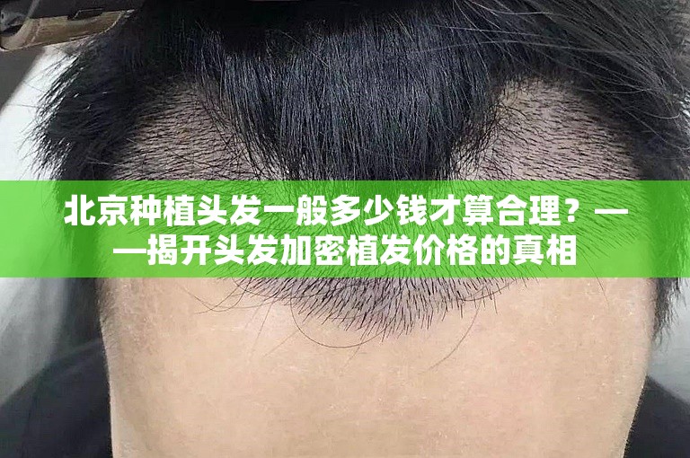 北京种植头发一般多少钱才算合理？——揭开头发加密植发价格的真相