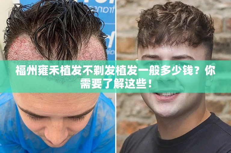 福州雍禾植发不剃发植发一般多少钱？你需要了解这些！