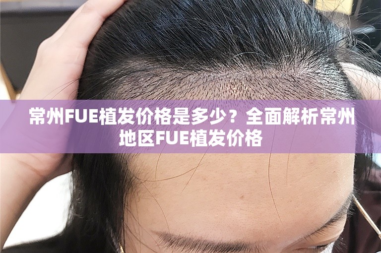 常州FUE植发价格是多少？全面解析常州地区FUE植发价格