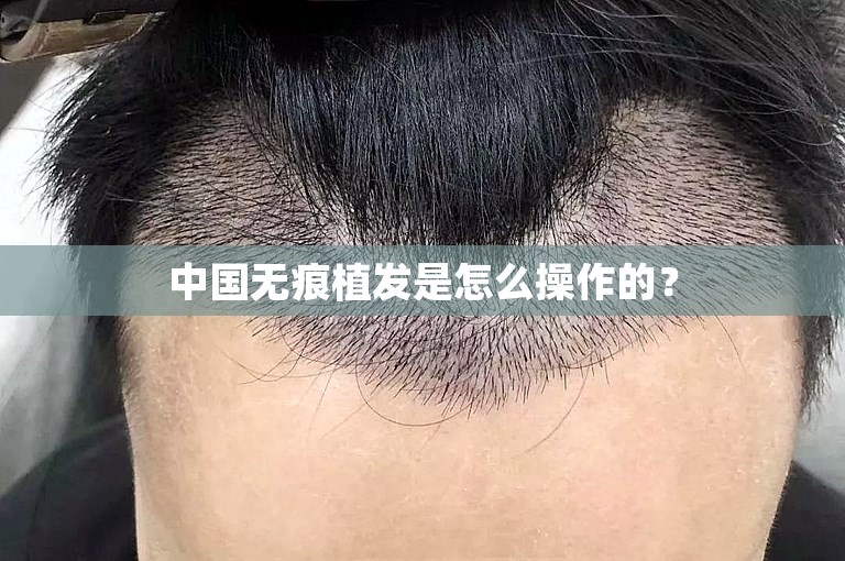 中国无痕植发是怎么操作的？