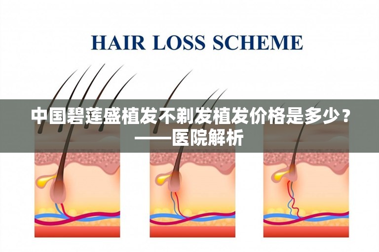 中国碧莲盛植发不剃发植发价格是多少？——医院解析