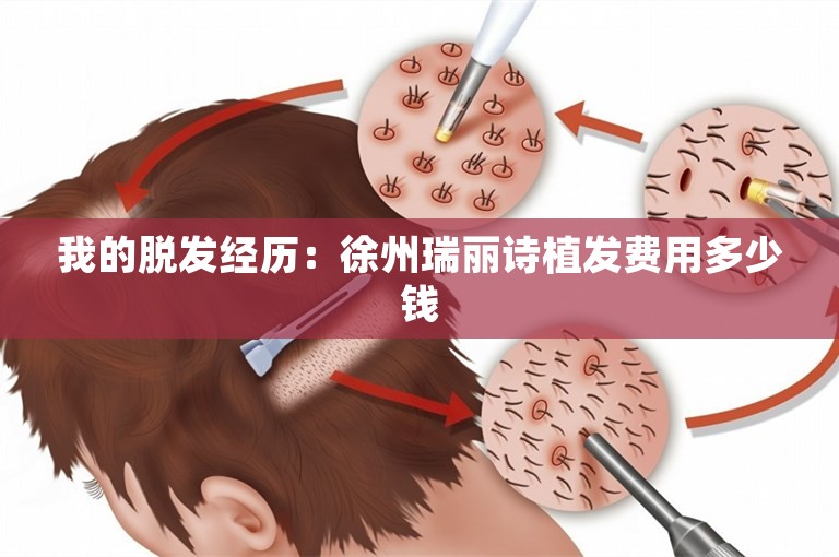 我的脱发经历：徐州瑞丽诗植发费用多少钱