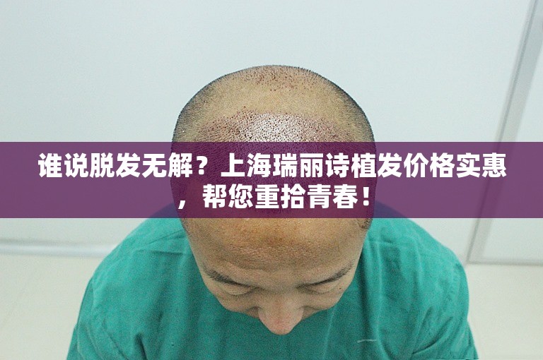 谁说脱发无解？上海瑞丽诗植发价格实惠，帮您重拾青春！