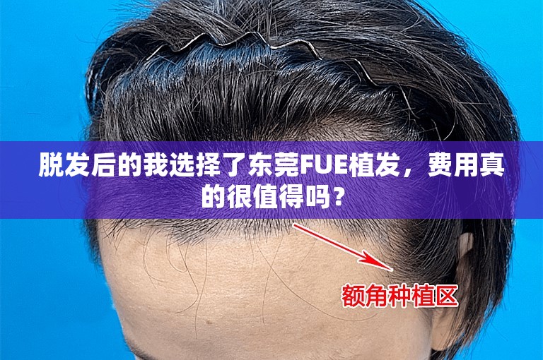 脱发后的我选择了东莞FUE植发，费用真的很值得吗？