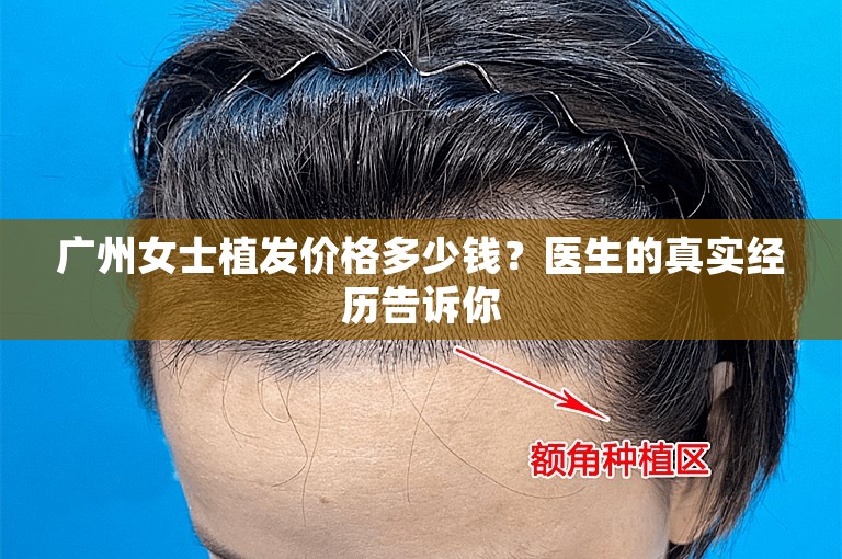 广州女士植发价格多少钱？医生的真实经历告诉你