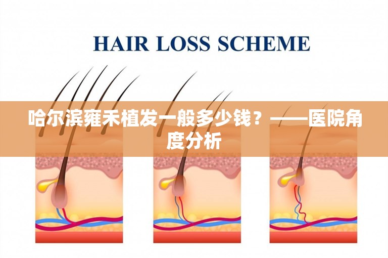 哈尔滨雍禾植发一般多少钱？——医院角度分析