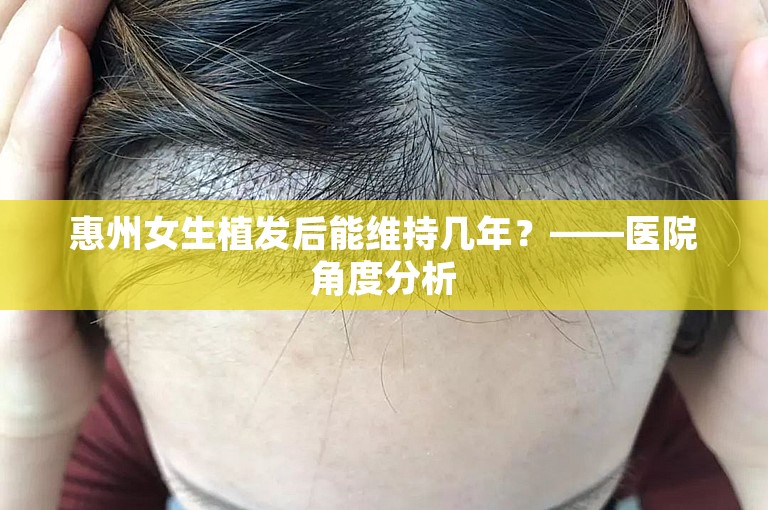 惠州女生植发后能维持几年？——医院角度分析