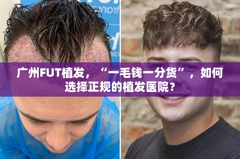 广州FUT植发，“一毛钱一分货”，如何选择正规的植发医院？