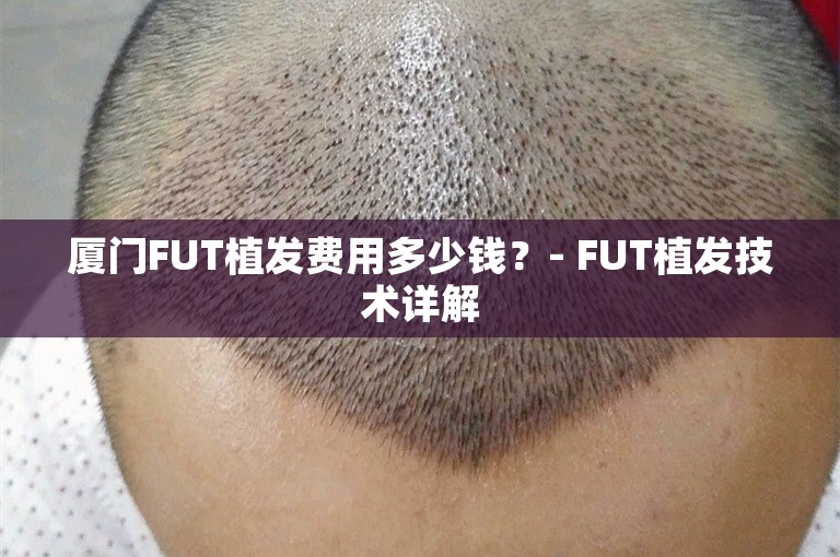 厦门FUT植发费用多少钱？- FUT植发技术详解