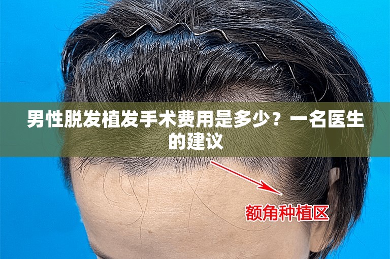 男性脱发植发手术费用是多少？一名医生的建议