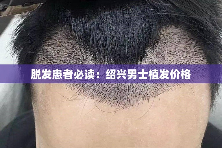 脱发患者必读：绍兴男士植发价格