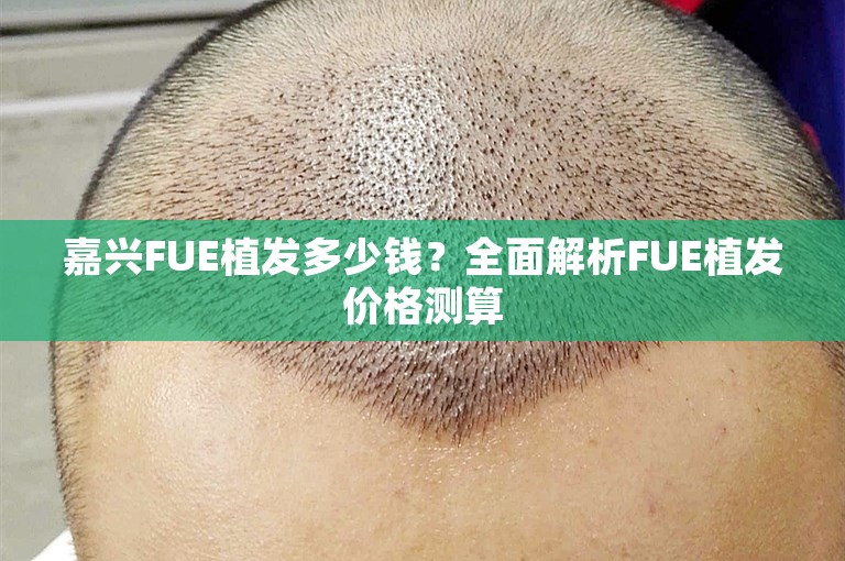 嘉兴FUE植发多少钱？全面解析FUE植发价格测算