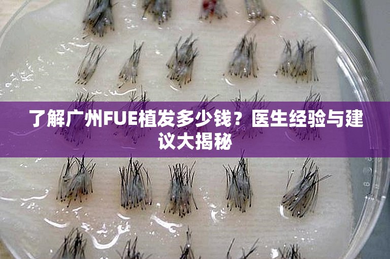 了解广州FUE植发多少钱？医生经验与建议大揭秘