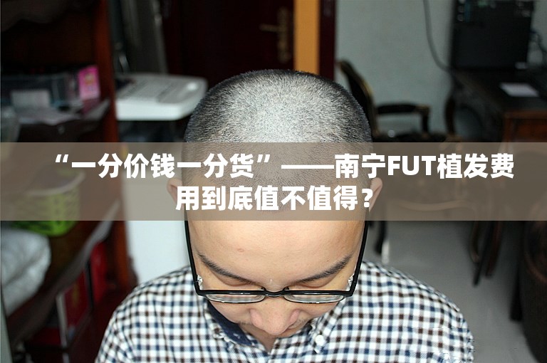 “一分价钱一分货”——南宁FUT植发费用到底值不值得？