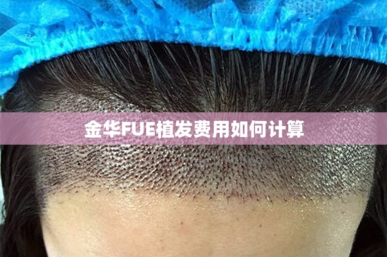 金华FUE植发费用如何计算