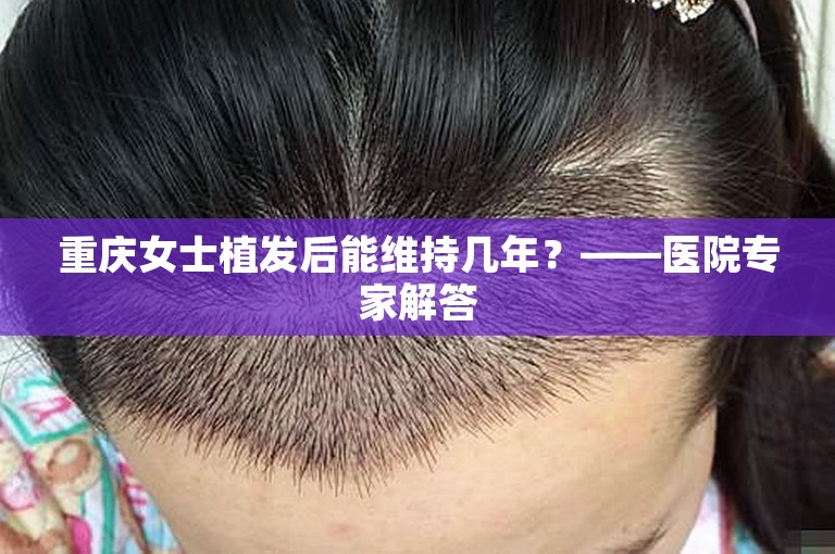 重庆女士植发后能维持几年？——医院专家解答