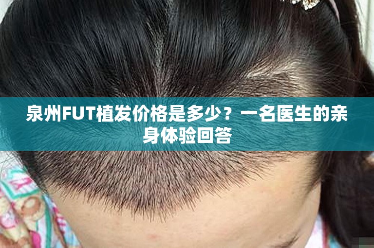 泉州FUT植发价格是多少？一名医生的亲身体验回答