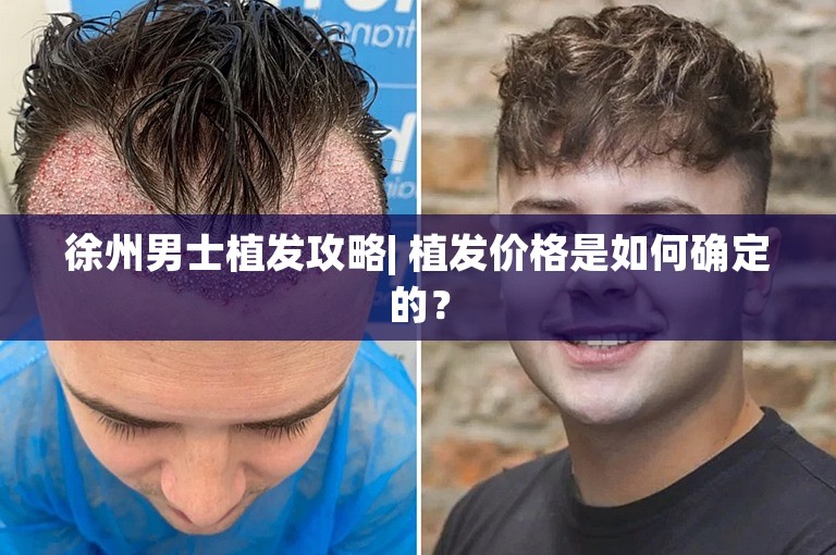 徐州男士植发攻略| 植发价格是如何确定的？