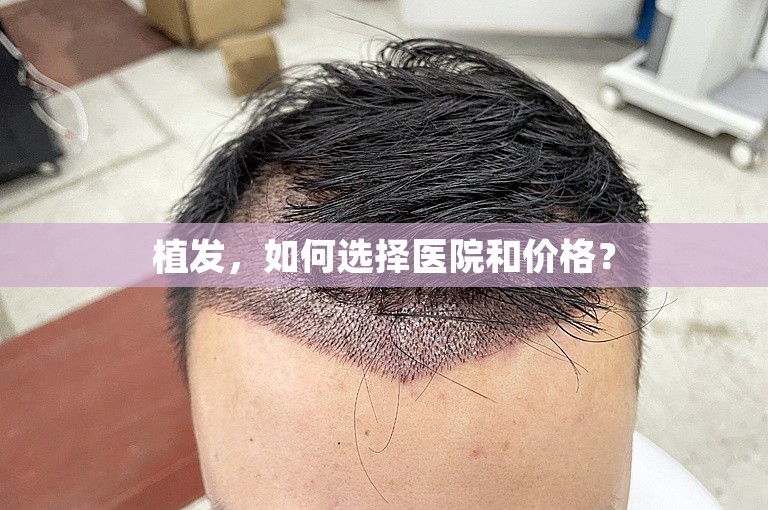 植发，如何选择医院和价格？