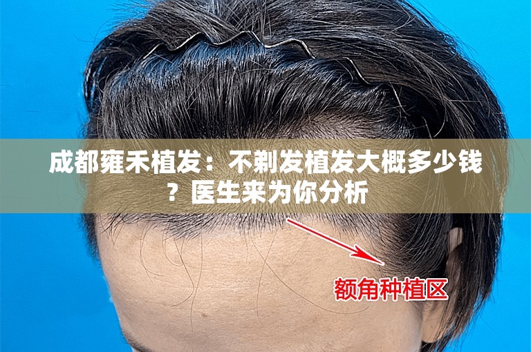 成都雍禾植发：不剃发植发大概多少钱？医生来为你分析