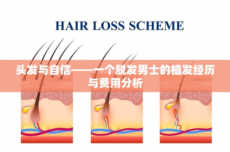 头发与自信——一个脱发男士的植发经历与费用分析