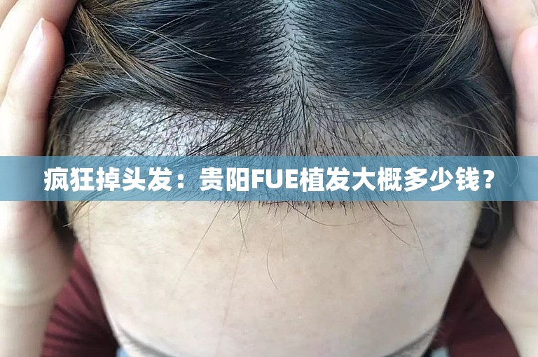 疯狂掉头发：贵阳FUE植发大概多少钱？