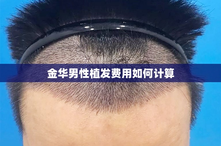 金华男性植发费用如何计算