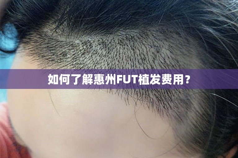 如何了解惠州FUT植发费用？