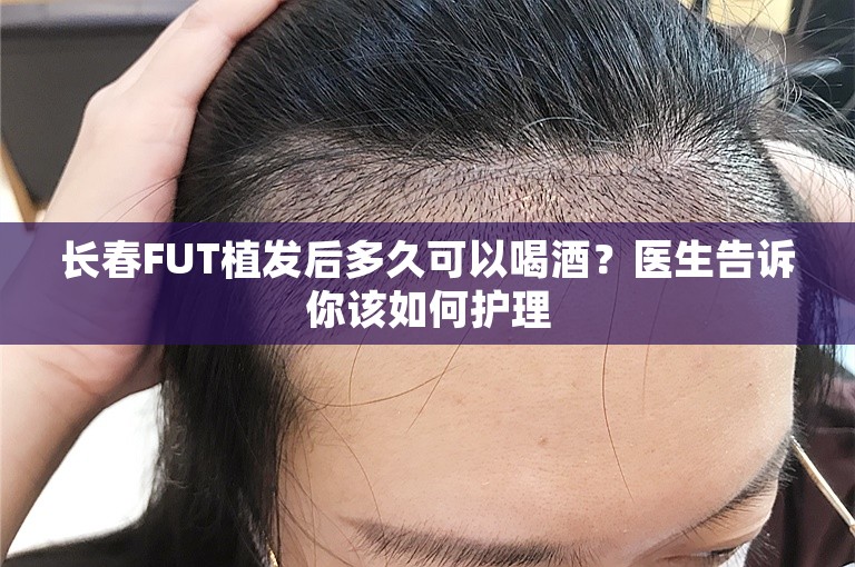 长春FUT植发后多久可以喝酒？医生告诉你该如何护理