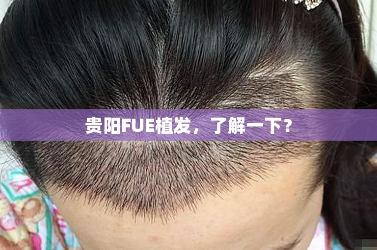 贵阳FUE植发，了解一下？