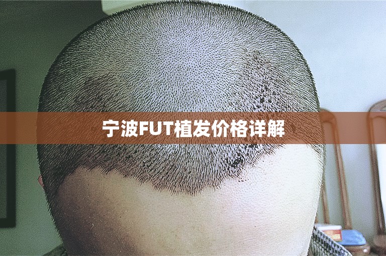 宁波FUT植发价格详解