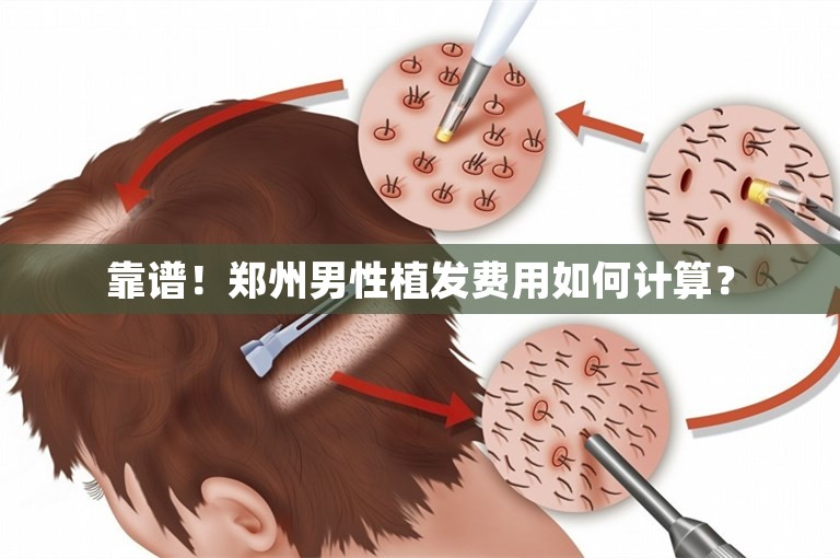 靠谱！郑州男性植发费用如何计算？