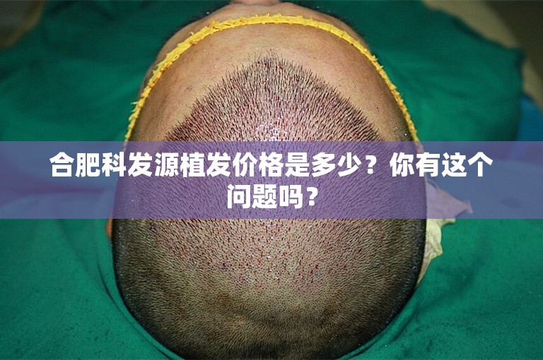 合肥科发源植发价格是多少？你有这个问题吗？