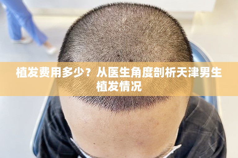 植发费用多少？从医生角度剖析天津男生植发情况