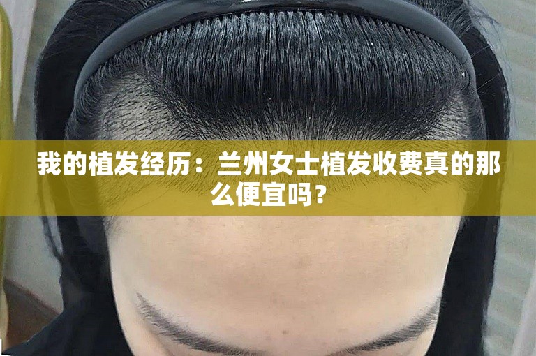 我的植发经历：兰州女士植发收费真的那么便宜吗？