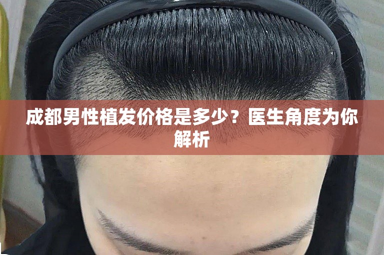 成都男性植发价格是多少？医生角度为你解析