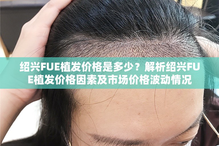 绍兴FUE植发价格是多少？解析绍兴FUE植发价格因素及市场价格波动情况