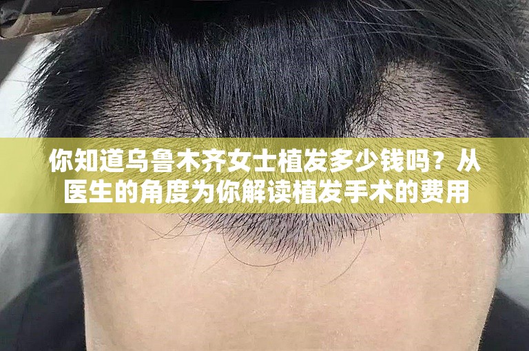 你知道乌鲁木齐女士植发多少钱吗？从医生的角度为你解读植发手术的费用